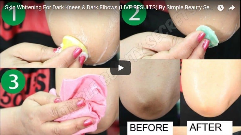 Skin whitening for dark knees and dark elbows