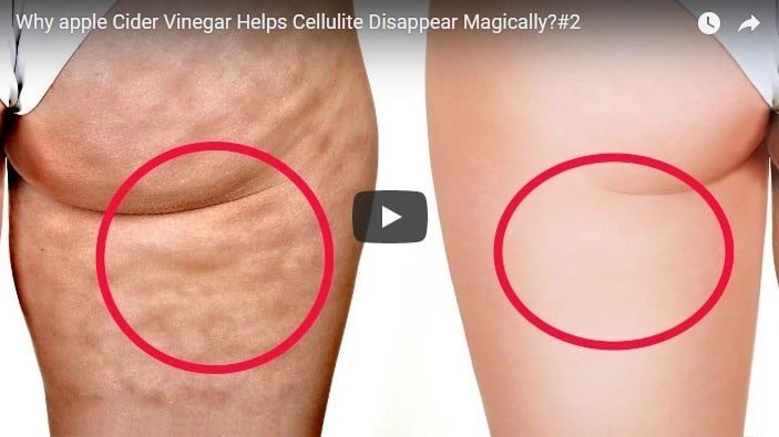 apple cider vinegar helps cellulite disappear