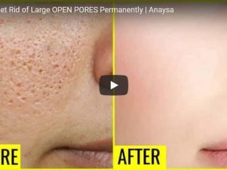 Large open pores