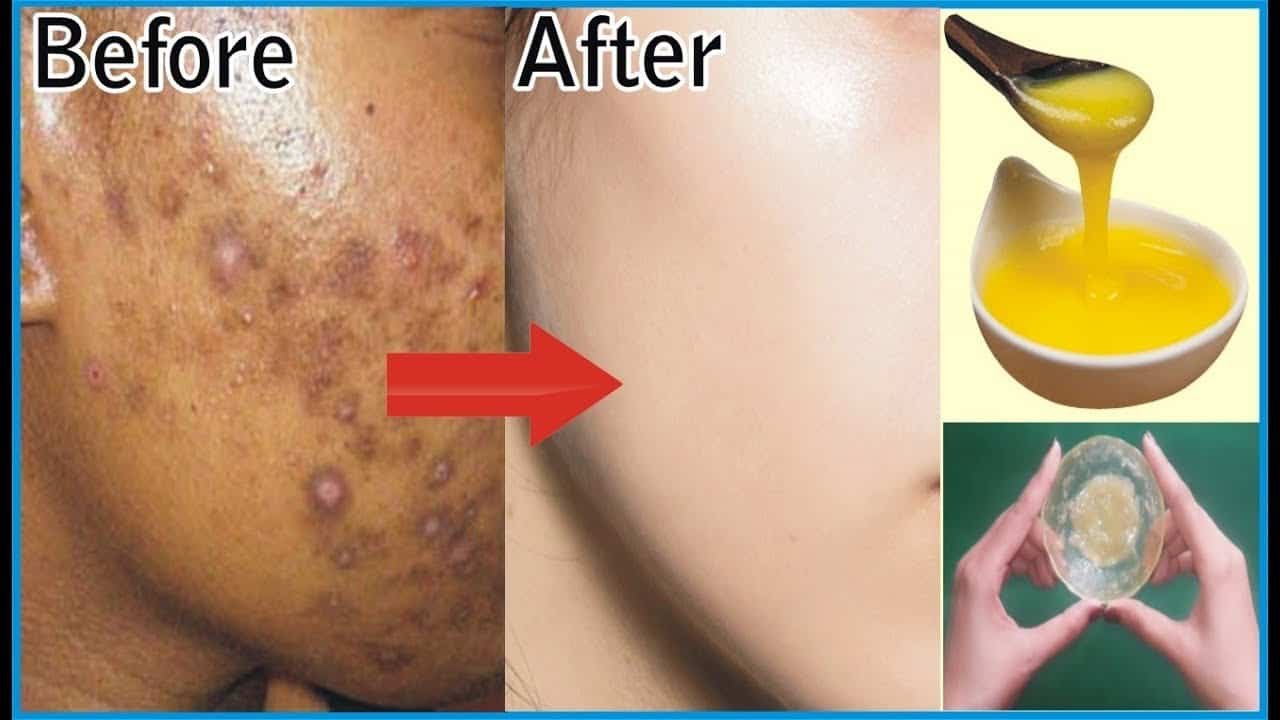 potato to treat skin pigmentation, dark spots, acne scars easily 