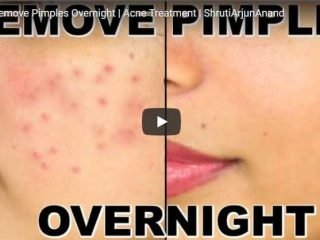 remove pimples overnight