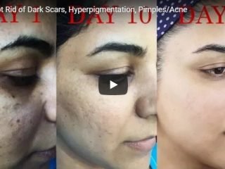 hyperpigmentation and pimples