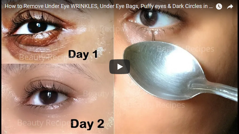 eye wrinkles, under eye bags, puffy eyes