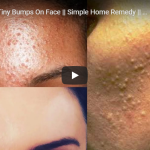 bumps on face