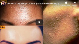 Get rid of tiny bumps on face