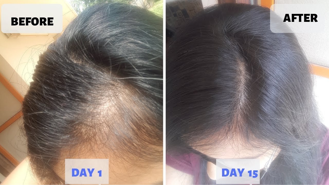 hair growth miracle treatment